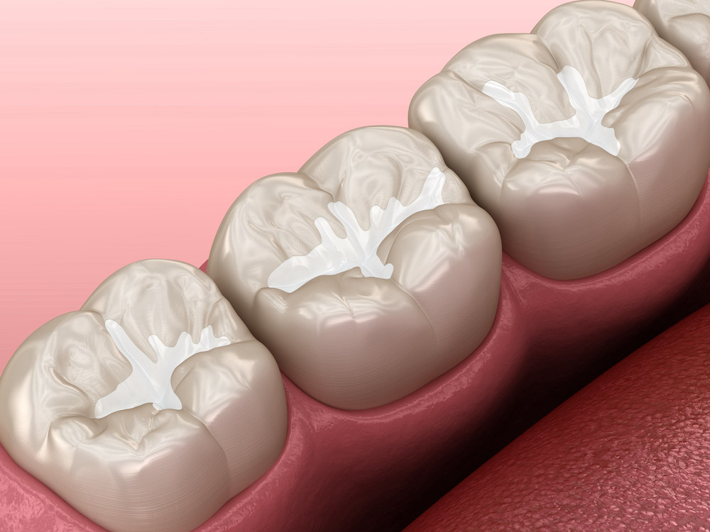 Fillings-Composite