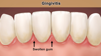 Gum disease_Gingivitis_1