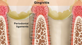 Gum disease_Gingivitis_2
