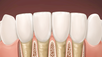Gum disease_Normal_2