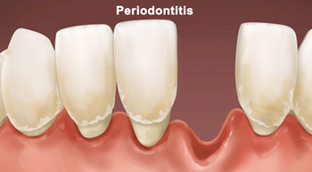 Gum disease_Periodontitis_1