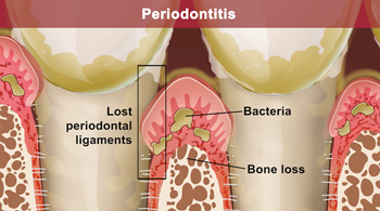 Gum disease_Periodontitis_2