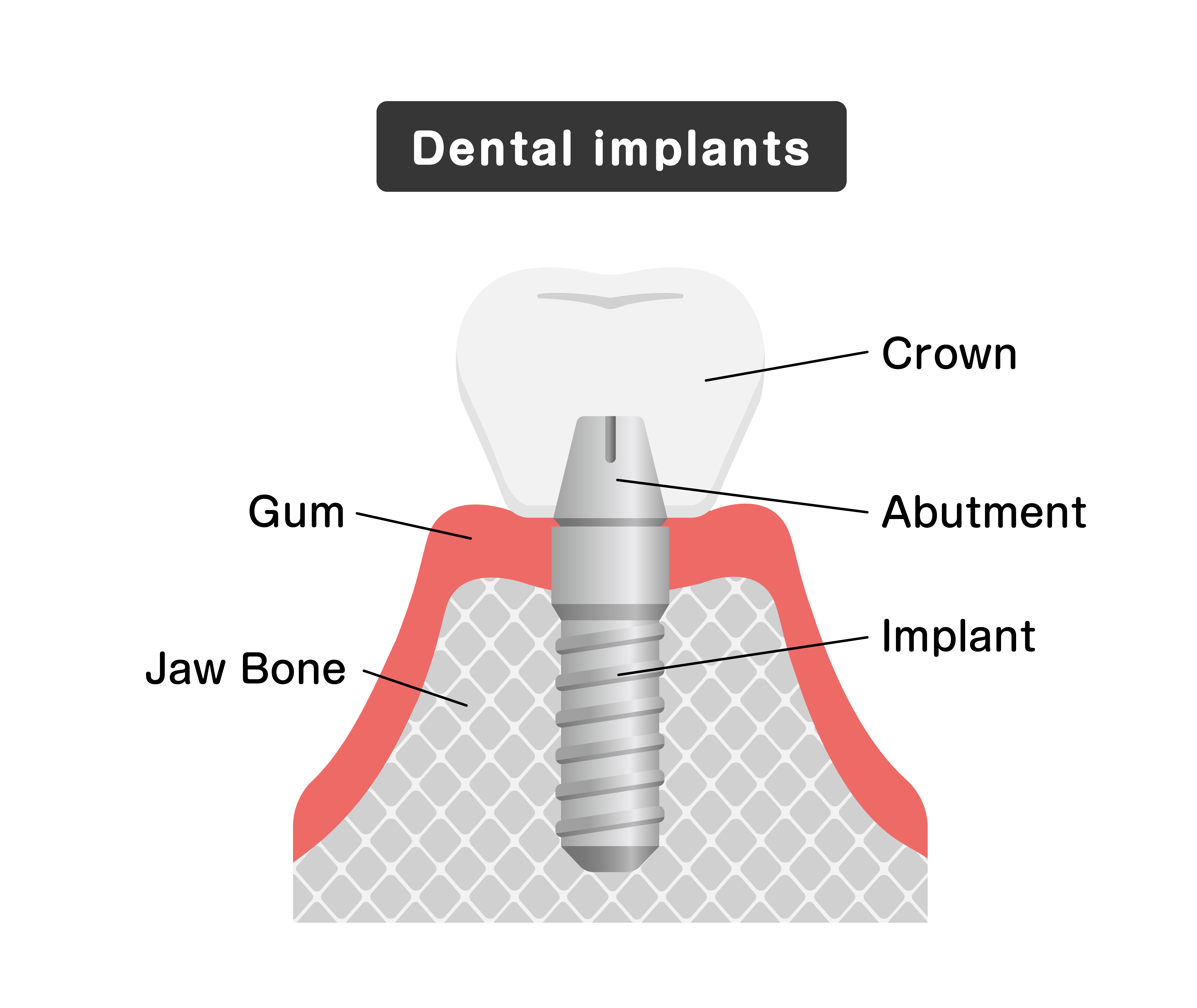 健康・医学 Implant Dentistry: Theory and Practice Implant Dentistry: Theory and Practice – Nova Science Publishers