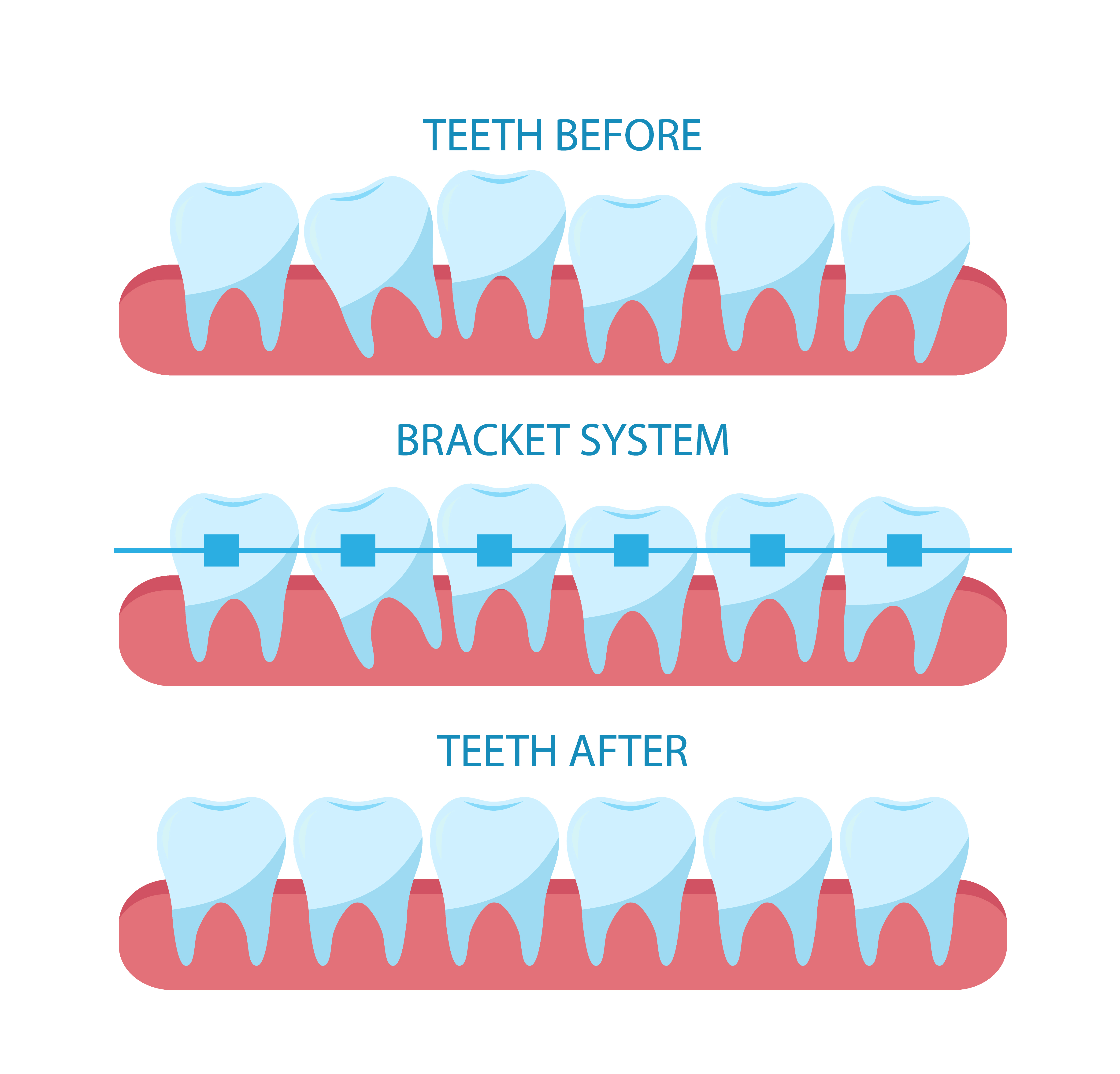 Orthodontics Bracket System