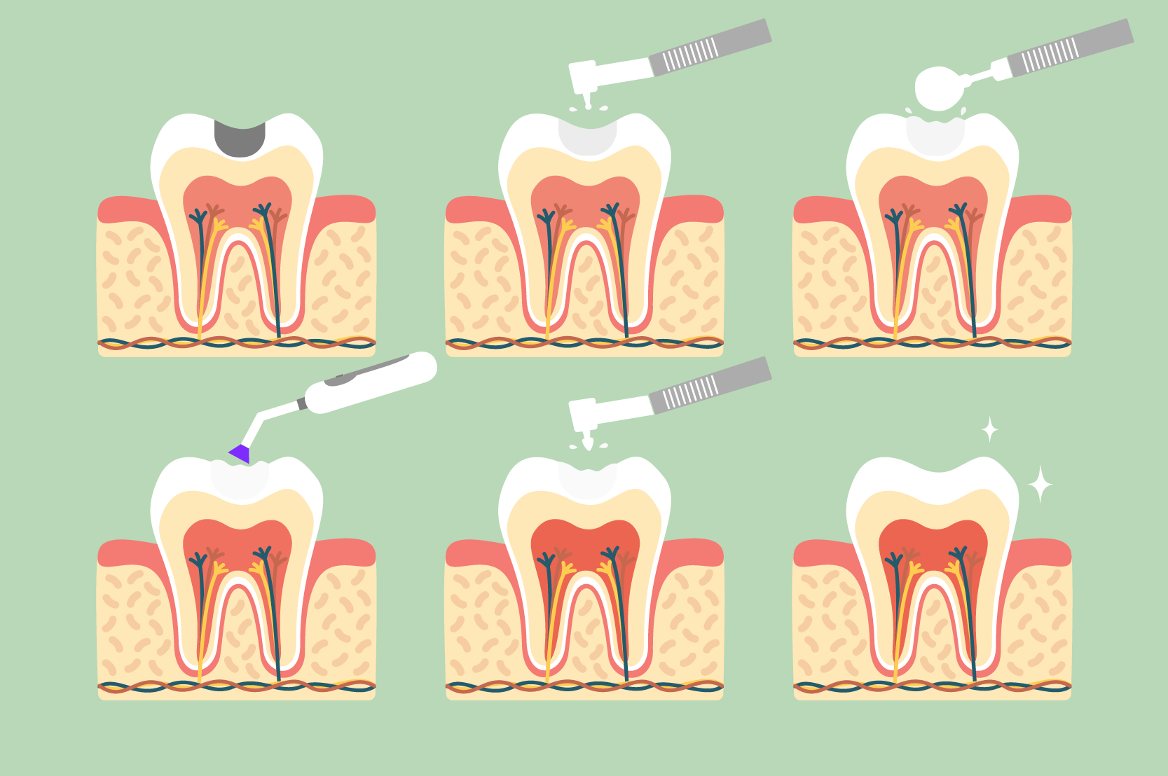 Fillings in Dentistry, What is it? Learn all about it.